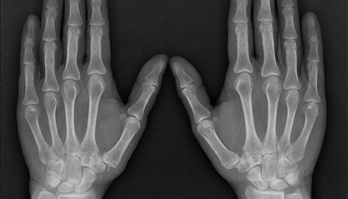 röntgen artriidi ja artroosi diagnoosimiseks