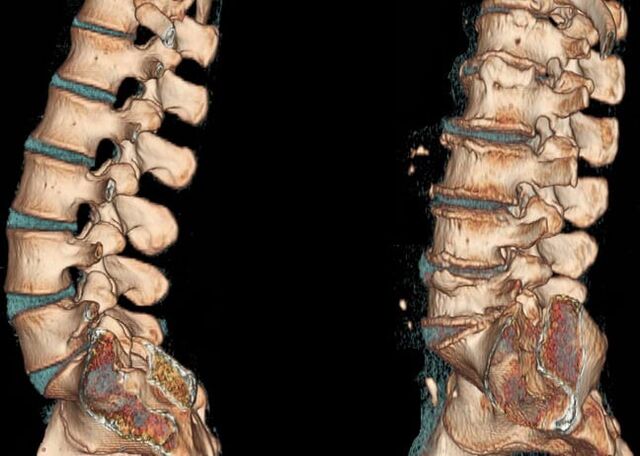 Nimmepiirkonna osteokondroos
